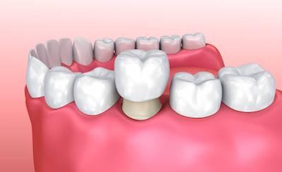 dental crowns illustration casino nsw