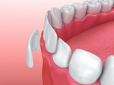 veneers illustration