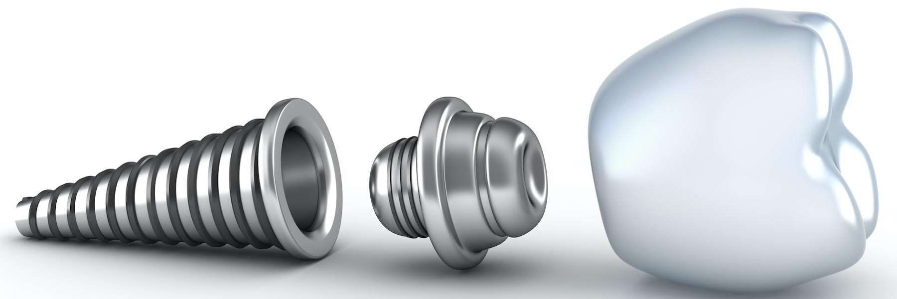 dental implants illustration