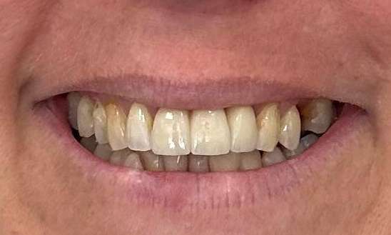 Anterior-Front-Dental-Bridge-After-Image