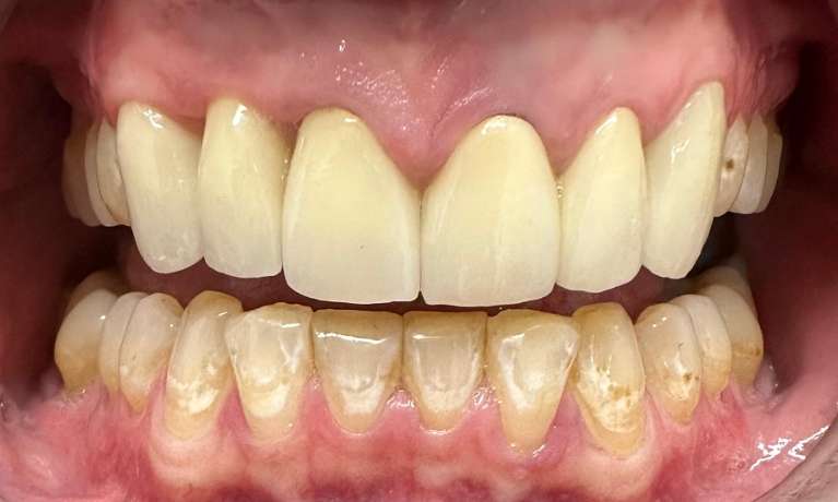 Ceramic-Crowns-and-Implant-Crown-on-Front-Tooth-After-Image