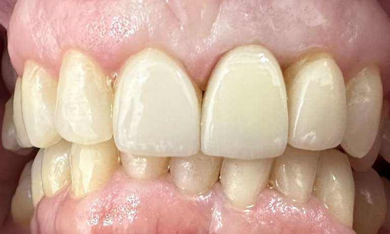 Implant-on-Front-Tooth-After-Image
