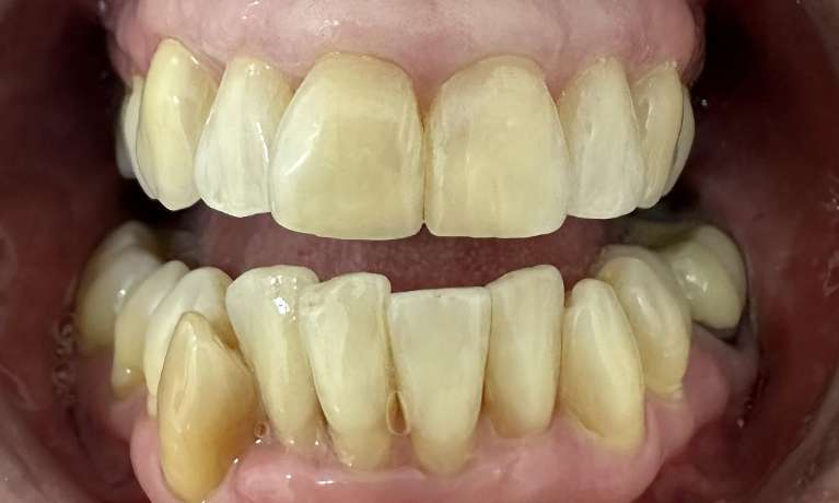 Replacement-of-Old-Worn-and-Discoloured-Fillings-on-Front-Teeth-After-Image