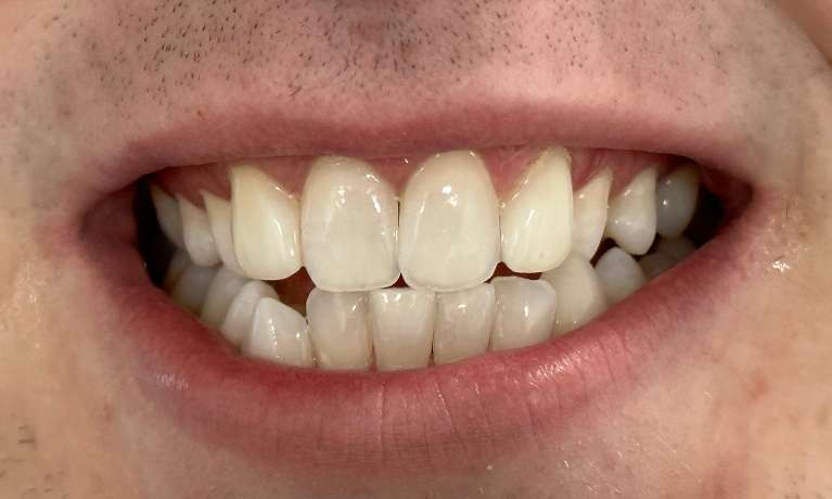 Smile-Design-missing-lateral-incisors-After-Image
