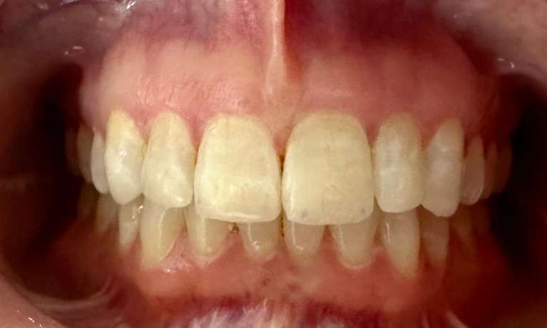 After Tooth-Coloured Filling