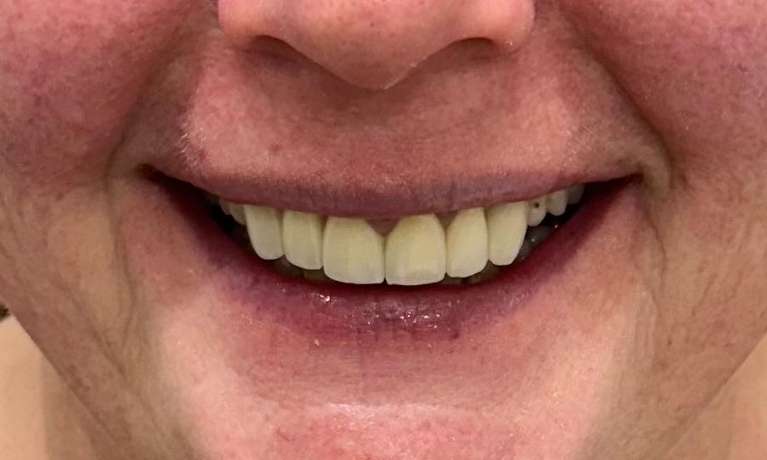 After Dental Implant