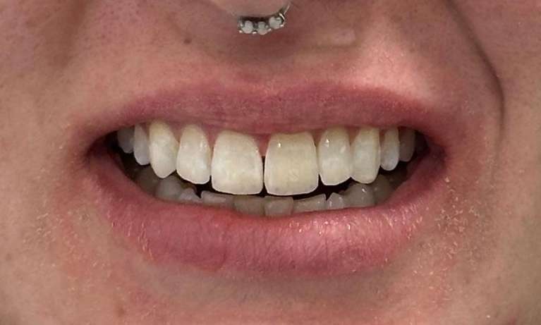 After Tooth-Coloured Restoration After Orthodontics