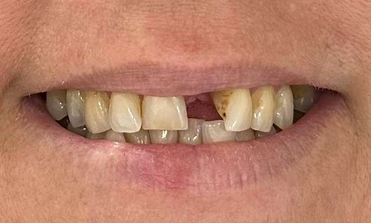 Anterior-Front-Dental-Bridge-Before-Image