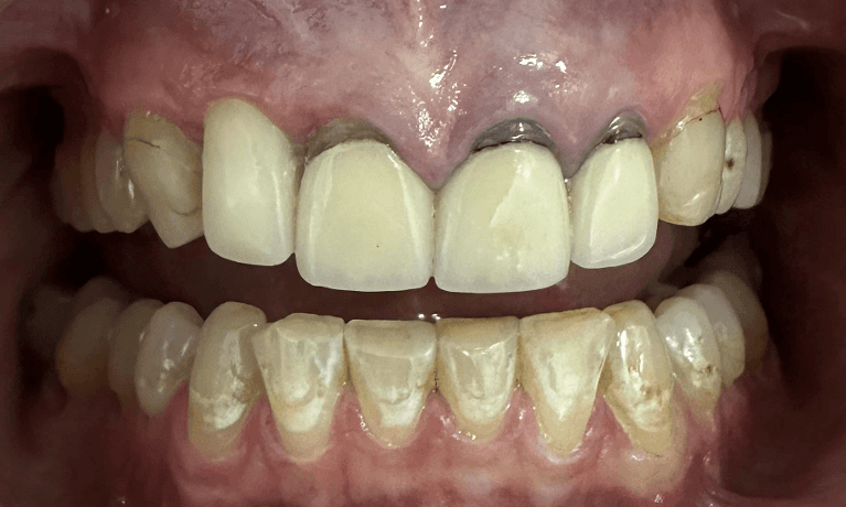 Ceramic-Crowns-and-Implant-Crown-on-Front-Tooth-Before-Image