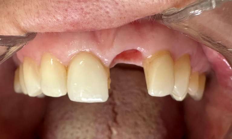 Implant-on-Front-Tooth-Before-Image