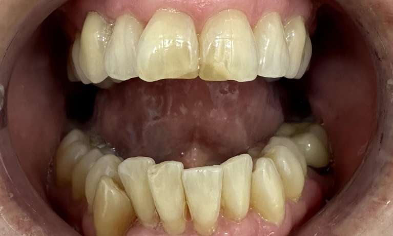 Replacement-of-Old-Worn-and-Discoloured-Fillings-on-Front-Teeth-Before-Image