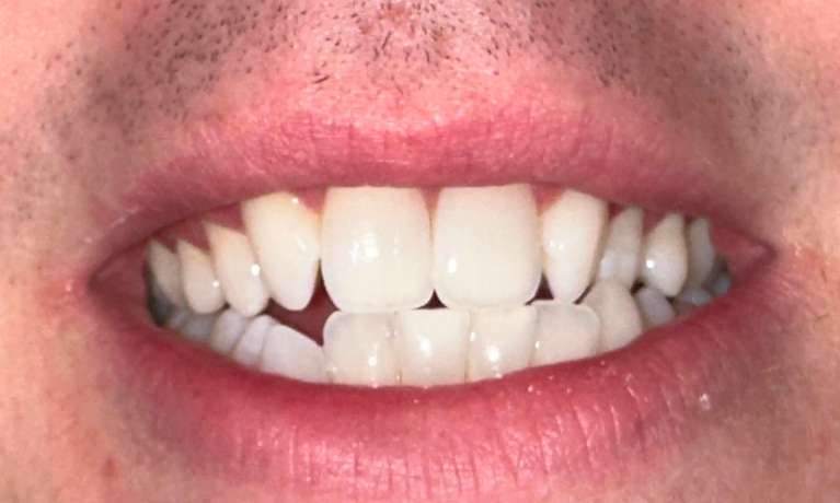 Smile-Design-missing-lateral-incisors-Before-Image