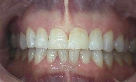 Before Tooth-Coloured Filling
