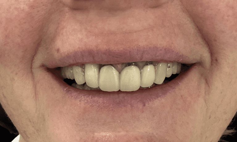 Before Dental Implant